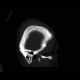 Fissure of skull, epidural hematoma: CT - Computed tomography